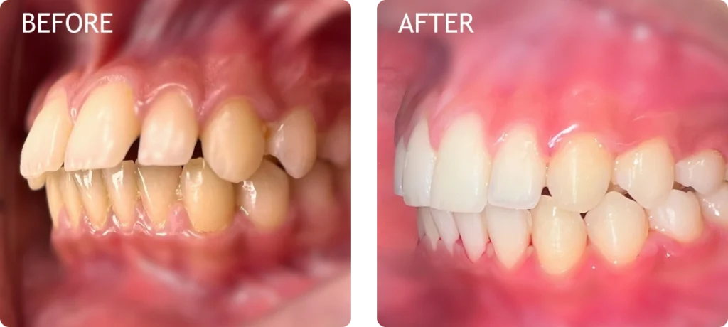 dental braces in dubai