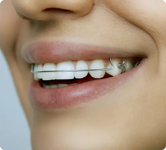 Teeth-Retainer-in-Dubai