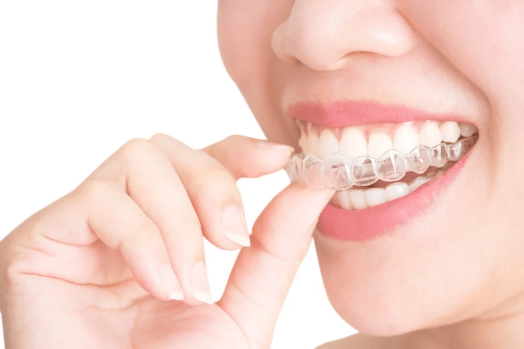 Aftercare Tips for Clear Aligners