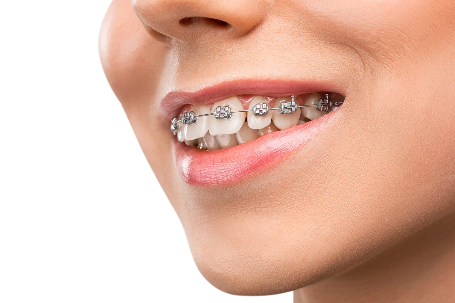 Dental Braces Aftercare Tips: The Best Guide