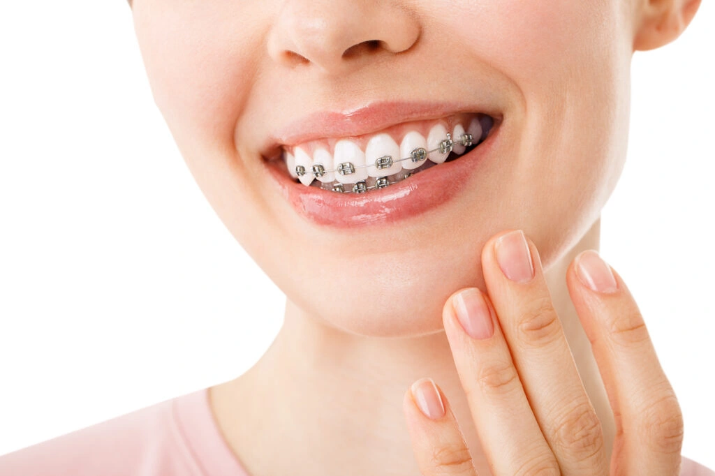 Exploring the Best Braces Options in Satwa: Enhance Your Smile at National Medical Center, Dubai