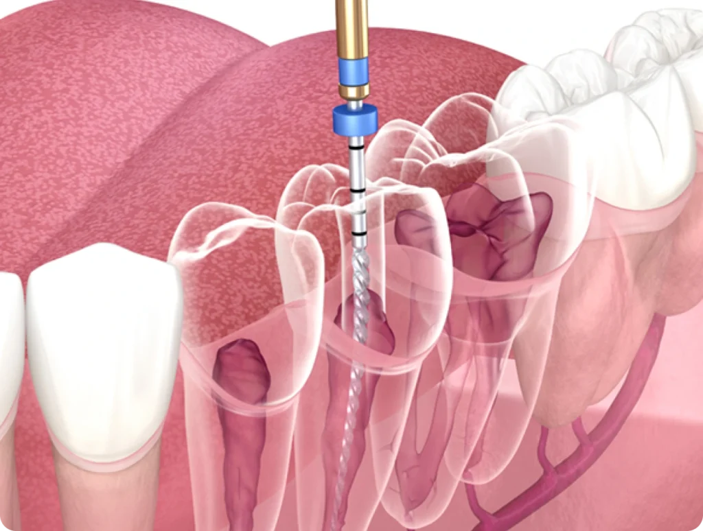 Root-Canal-Treatment-Dubai