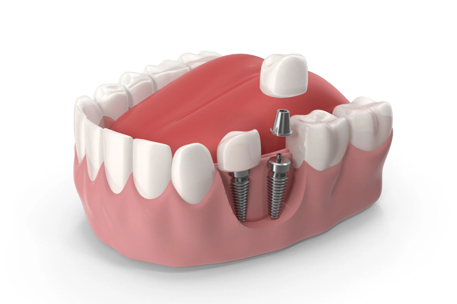 Dental-Implants-in-Dubai