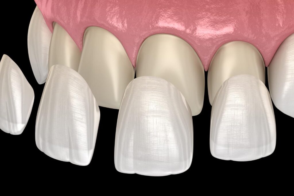 Benefits-of-dental-veneers