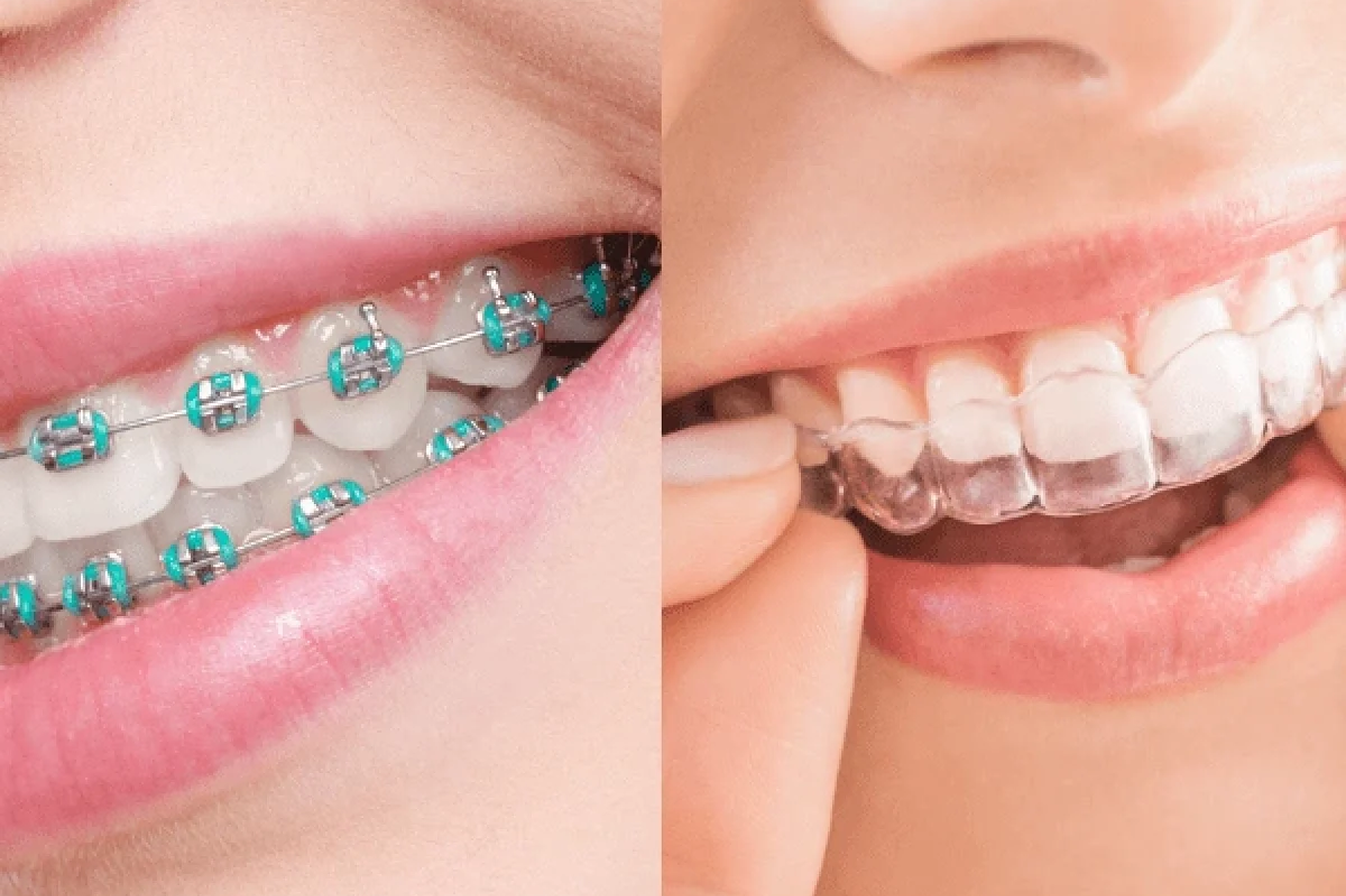 Benefits of Invisalign over braces