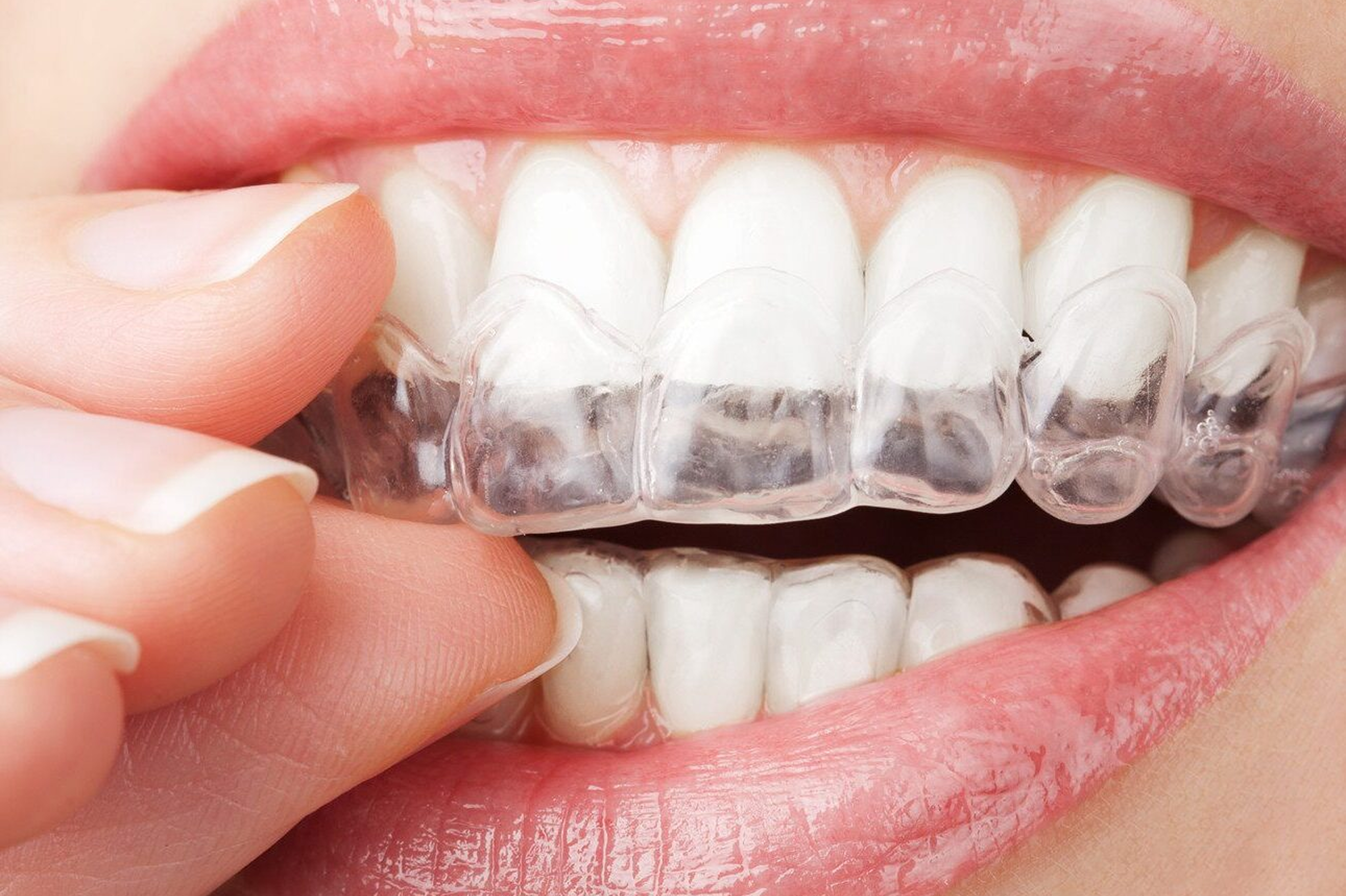 What Are Clear Aligners & How Do Clear Aligners Straighten Teeth