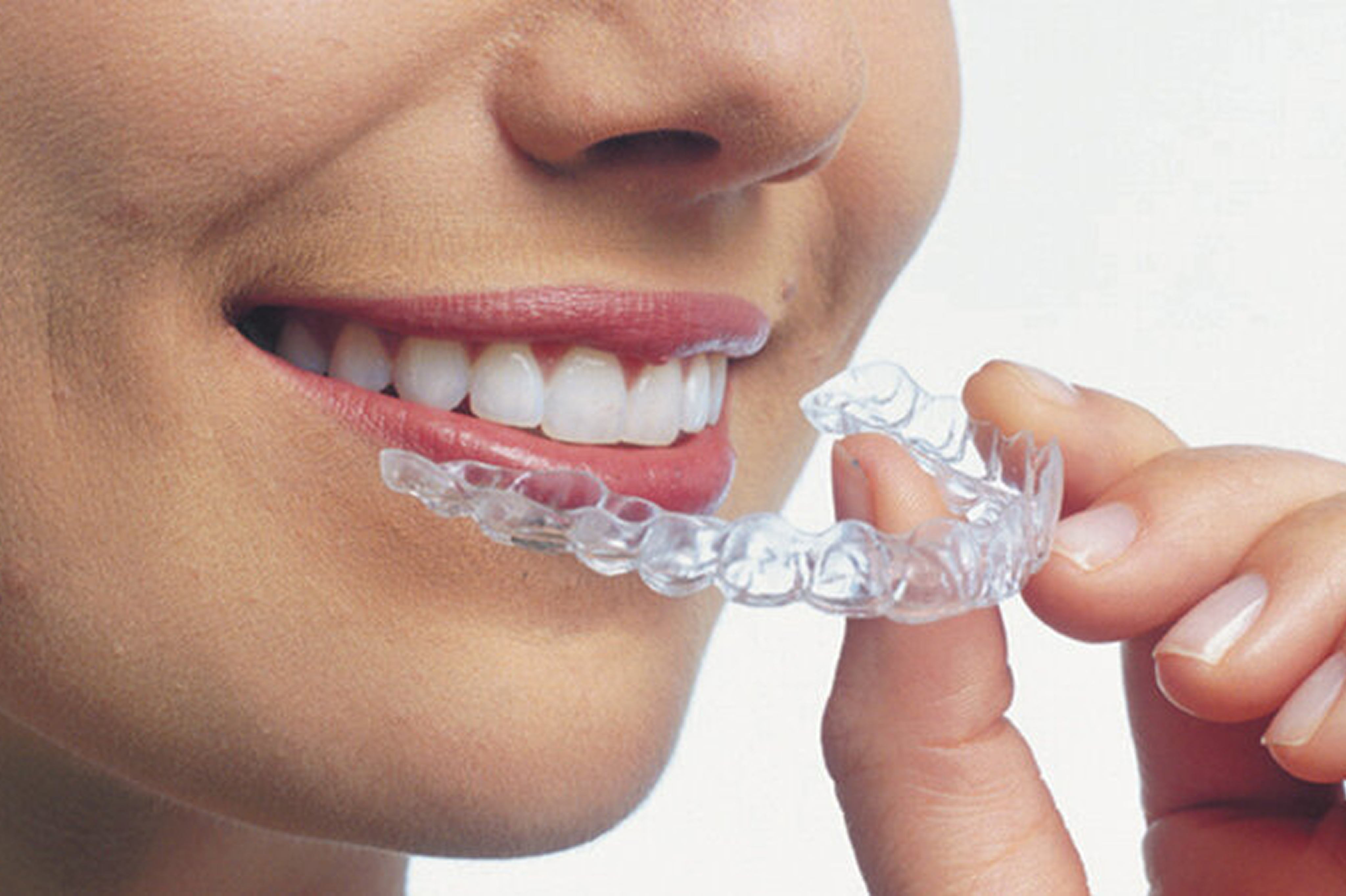 Differences between Invisalign and clear aligners