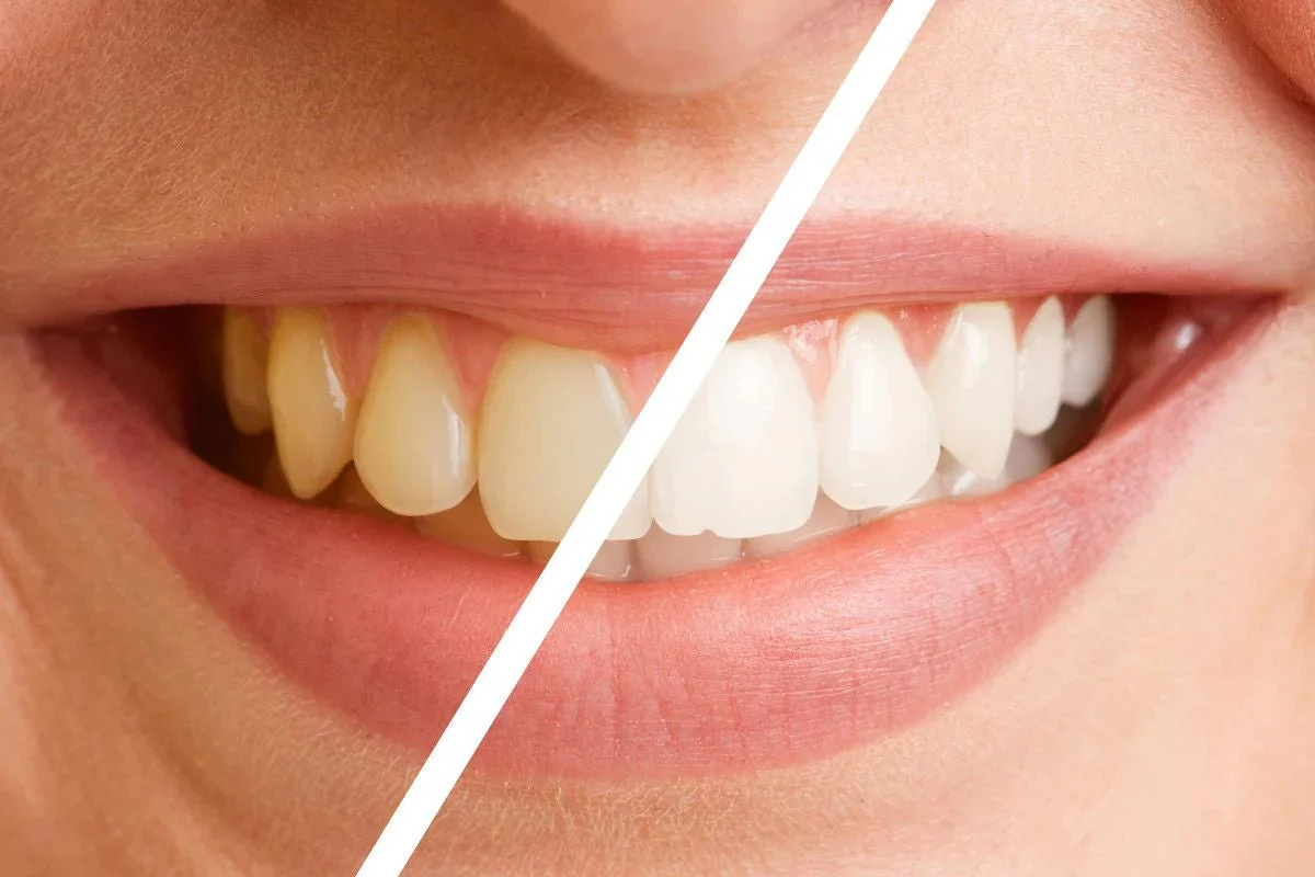 What are the Benefits of Zoom teeth Whitening?